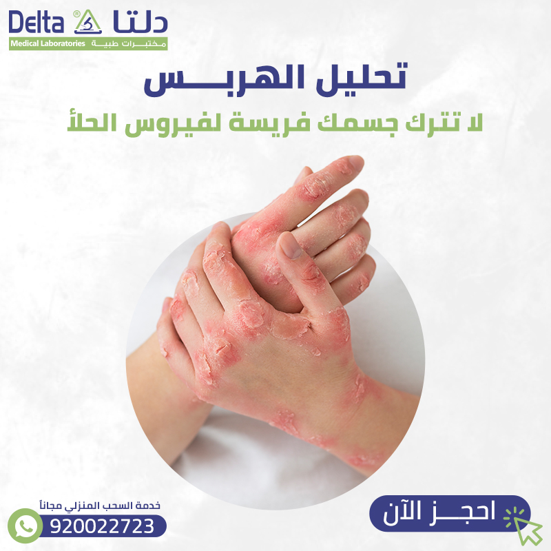 تحليل الهربس: لا تترك جسمك فريسة لفيروس الحلأ (واحجز الآن)