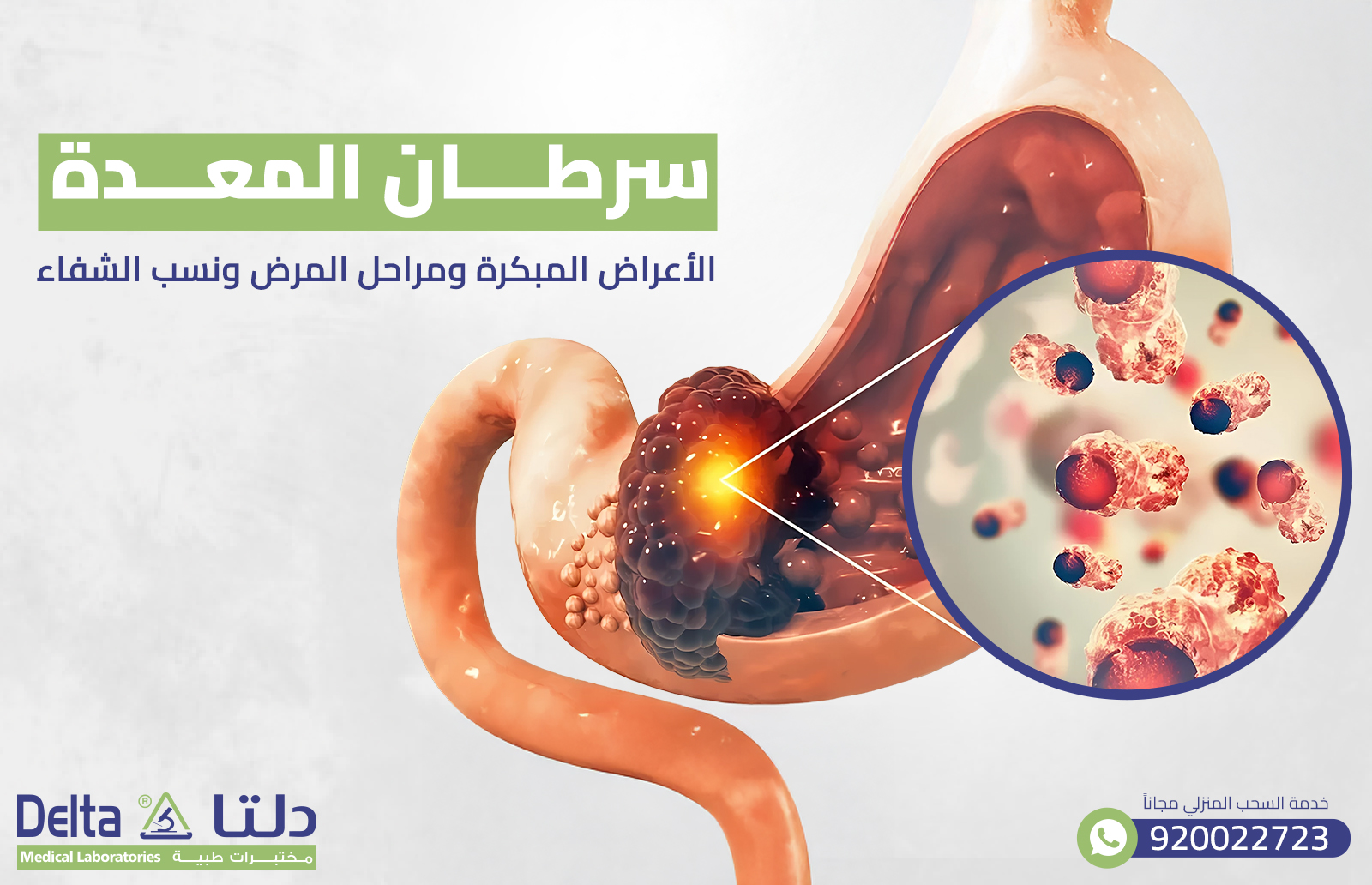 سرطان المعدة : الأعراض المبكرة ومراحل المرض ونسب الشفاء